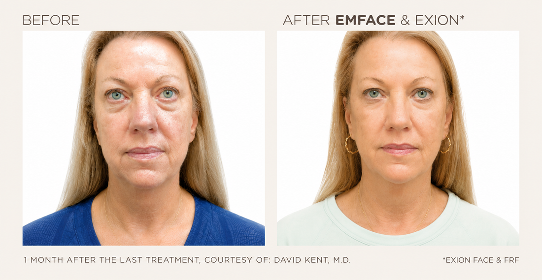 Does EmFace Really Work? The Science Behind the Treatment