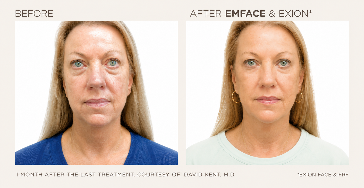 Does EmFace Really Work? The Science Behind the Treatment