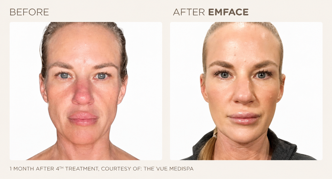 How to Lift Drooping Cheeks Without Surgery