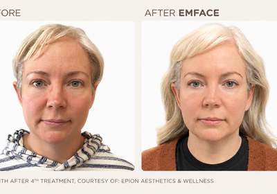How Many EmFace Treatments Do I Need?
