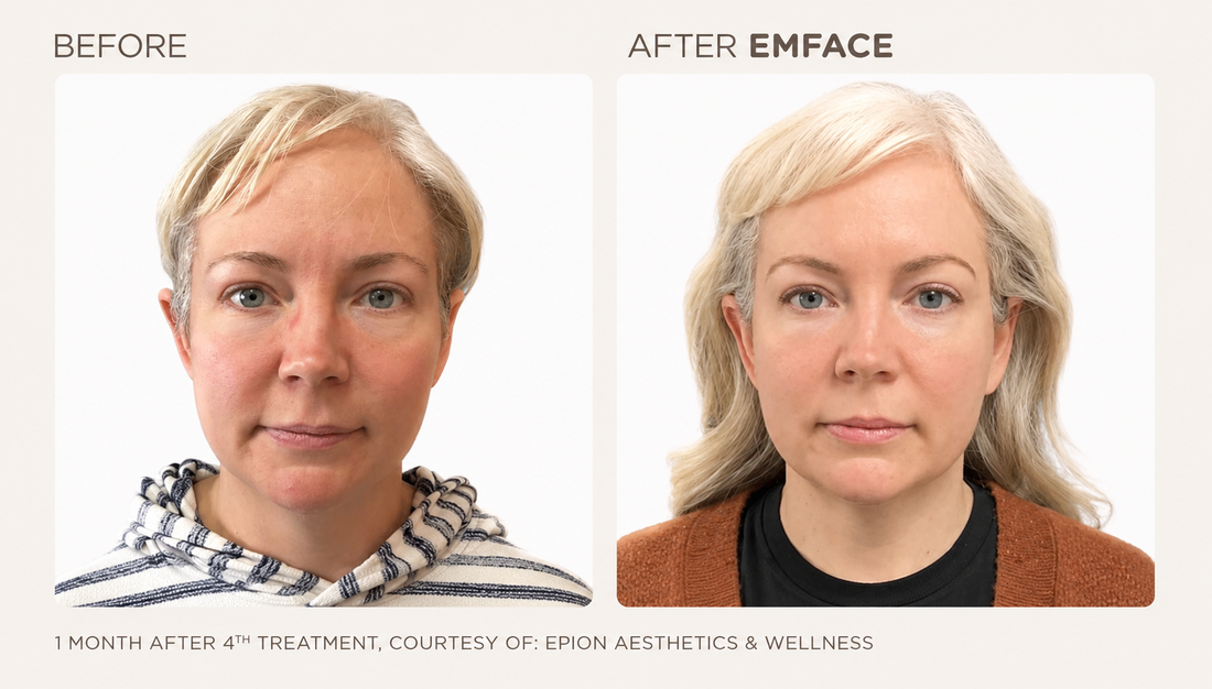 How Many EmFace Treatments Do I Need?