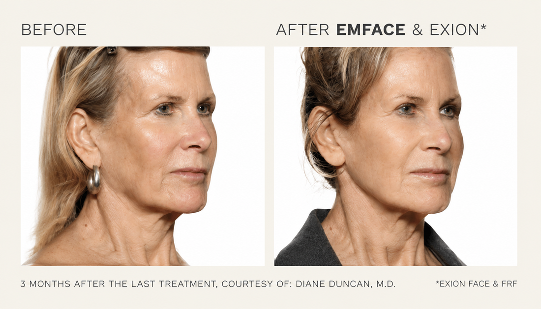 EmFace vs Exion: Which Treatment Is Right for You?
