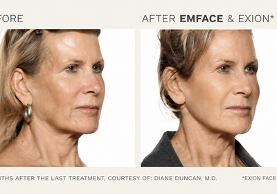 Is EmFace Worth It? An Honest Look at the Results